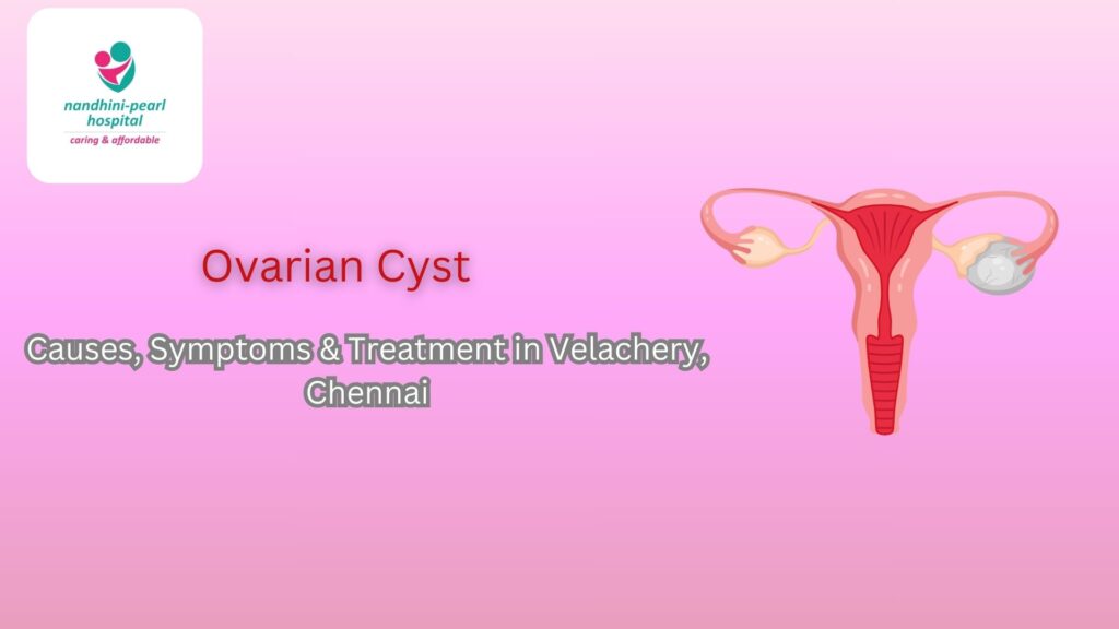 Ovarian Cyst: Causes, Symptoms & Treatment in Velachery, Chennai