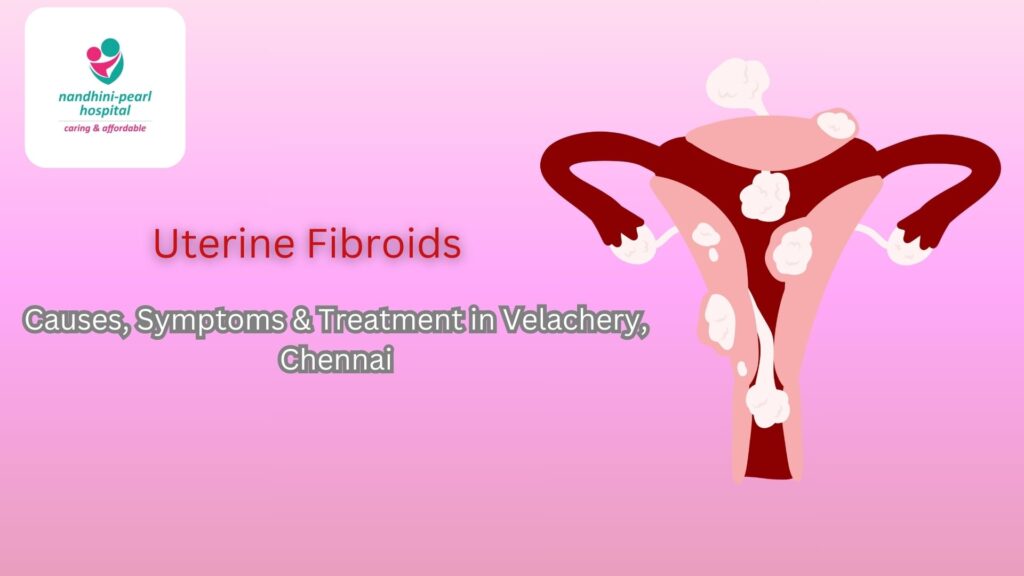 Uterine Fibroids: Causes, Symptoms & Treatment in Velachery, Chennai