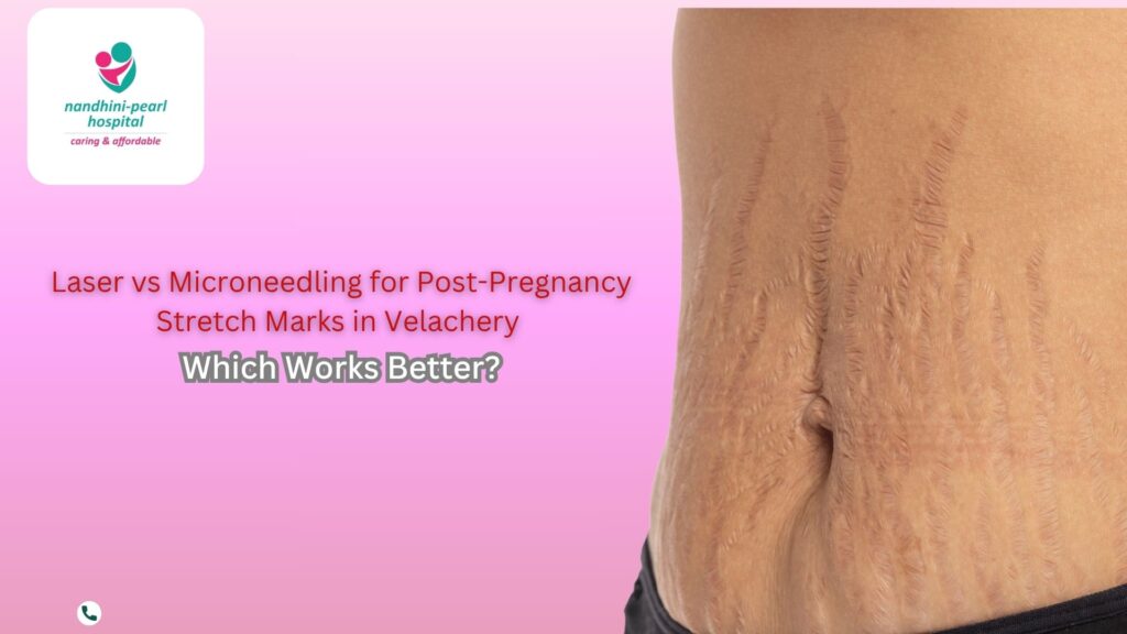 Laser vs Microneedling for Post-Pregnancy Stretch Marks in Velachery – Which Works Better?